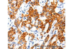 Immunohistochemistry of Human cervical cancer using SLC2A11 Polyclonal Antibody at dilution of 1:140 (SLC2A11 anticorps)