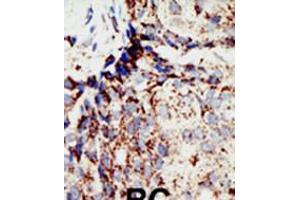 Formalin-fixed and paraffin-embedded human cancer tissue reacted with the primary antibody, which was peroxidase-conjugated to the secondary antibody, followed by DAB staining.