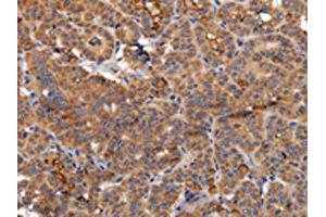 The image on the left is immunohistochemistry of paraffin-embedded Human thyroid cancer tissue using ABIN7130361(NDUFA1 Antibody) at dilution 1/70, on the right is treated with fusion protein. (NDUFA1 anticorps)