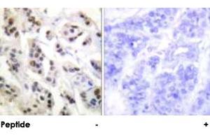 Immunohistochemical analysis of paraffin-embedded human breast carcinoma tissue using LMNA polyclonal antibody . (Lamin A/C anticorps)