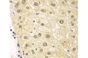 Immunohistochemistry of paraffin-embedded Human liver damage using PSMD2 Polyclonal Antibody at dilution of 1:100 (40x lens). (PSMD2 anticorps)