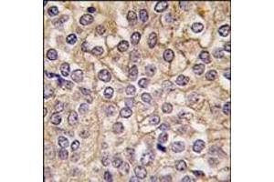 Formalin-fixed and paraffin-embedded human prostata carcinoma tissue reacted with IL1R antibody (C-term), which was peroxidase-conjugated to the secondary antibody, followed by DAB staining. (IL1RL2 anticorps  (C-Term))