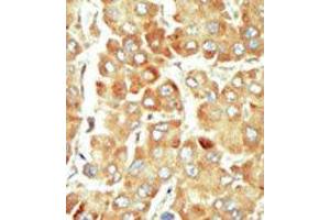 Formalin-fixed and paraffin-embedded human cancer tissue reacted with the primary antibody, which was peroxidase-conjugated to the secondary antibody, followed by DAB staining.