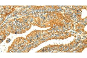 Immunohistochemistry of paraffin-embedded Human colon cancer tissue using GK1 Polyclonal Antibody at dilution 1:60 (Glycerol Kinase anticorps)