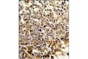 Formalin-fixed and paraffin-embedded human lymphoma reacted with NCF4 Antibody (C-term), which was peroxidase-conjugated to the secondary antibody, followed by DAB staining. (NCF4 anticorps  (C-Term))