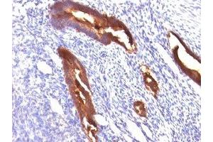 Formalin-fixed, paraffin-embedded human endometrial carcinoma stained with EMA antibody (MUC1/845). (MUC1 anticorps)