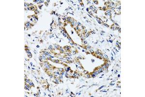 Immunohistochemistry of paraffin-embedded human colon carcinoma using ATP5B antibody.