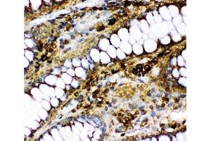 IHC-P: p73 antibody testing of human intestinal cancer tissue