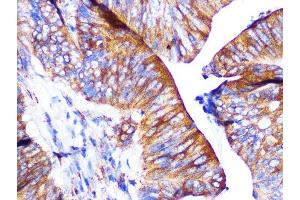 Immunohistochemistry of paraffin-embedded human colon carcinoma using P Rabbit mAb (ABIN1683023, ABIN7101760, ABIN7101761 and ABIN7101762) at dilution of 1:100 (40x lens).
