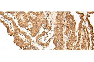 Immunohistochemistry of paraffin-embedded Human thyroid cancer tissue using VPS50 Polyclonal Antibody at dilution of 1:45(x200) (Syndetin/VPS50 anticorps)