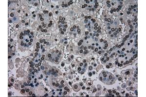 Immunohistochemical staining of paraffin-embedded Carcinoma of kidney tissue using anti-NRBP1mouse monoclonal antibody. (NRBP1 anticorps)