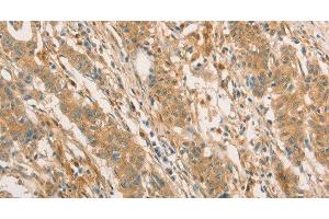 Immunohistochemistry of paraffin-embedded Human gastric cancer using CPB1 Polyclonal Antibody at dilution of 1:60