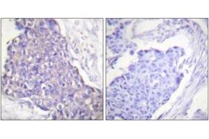 Immunohistochemistry analysis of paraffin-embedded human breast carcinoma tissue, using CD40 Antibody. (CD40 anticorps  (AA 228-277))