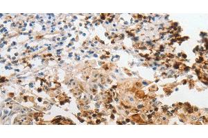 Immunohistochemistry of paraffin-embedded Human cervical cancer using LCN2 Polyclonal Antibody at dilution of 1:60 (Lipocalin 2 anticorps)