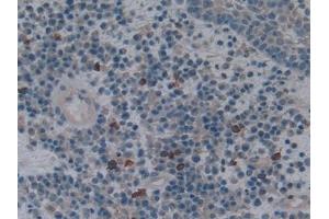 Detection of HO1 in Human Skin cancer Tissue using Polyclonal Antibody to Heme Oxygenase 1 (HO1)