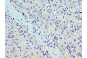 Immunohistochemistry of paraffin-embedded human liver cancer using ABIN7174459 at dilution of 1:100