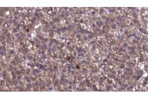 ABIN6276846 at 1/100 staining Human liver cancer tissue by IHC-P. (GABRG2 anticorps  (N-Term))