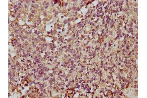 IHC image of ABIN7173067 diluted at 1:350 and staining in paraffin-embedded human ovarian cancer performed on a Leica BondTM system. (TMEM14A anticorps  (AA 45-78))