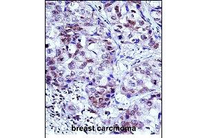 HIST1H1D Antibody (Center) (ABIN657667 and ABIN2846660) immunohistochemistry analysis in formalin fixed and paraffin embedded human breast carcinoma followed by peroxidase conjugation of the secondary antibody and DAB staining.