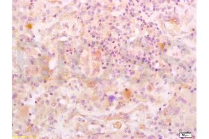 Formalin-fixed and paraffin embedded human glioma labeled with Anti-IGFBP2 Polyclonal Antibody, Unconjugated (ABIN737781) at 1:200 followed by conjugation to the secondary antibody and DAB staining.