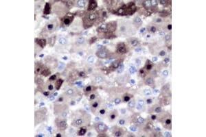 Immunohistochemical analysis of XPO2 staining in human liver cancer formalin fixed paraffin embedded tissue section. (Exportin 2 anticorps  (N-Term))