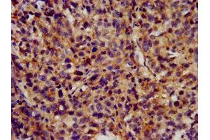 IHC image of ABIN7163969 diluted at 1:300 and staining in paraffin-embedded human ovarian cancer performed on a Leica BondTM system. (KCNC3 anticorps  (AA 638-745))