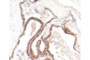 Formalin-fixed, paraffin-embedded human prostate cancer stained with p27Kip1 antibody (KIP1/769)