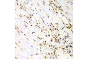 Immunohistochemistry of paraffin-embedded human gastric cancer using LHX4 antibody at dilution of 1:100 (x400 lens).