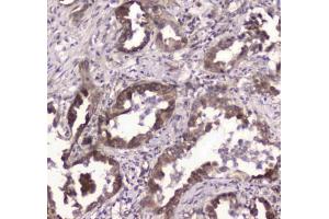IHC testing of FFPE human lung cancer tissue with GLO1 antibody at 1ug/ml. (GLO1 anticorps)