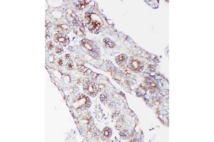 Anti-PCSK9 antibody, IHC(P): Human Intestinal Cancer Tissue (PCSK9 anticorps  (C-Term))