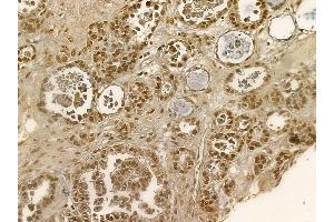 Nucleophosmin Mouse Monoclonal Antibody at 1/100 staining human ovarian cancer by IHC-P.