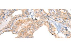 Immunohistochemistry of paraffin-embedded Human thyroid cancer tissue using RGS19 Polyclonal Antibody at dilution of 1:40(x200) (RGS19 anticorps)