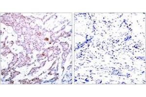 Immunohistochemistry analysis of paraffin-embedded human breast carcinoma, using NF-kappaB p65 (Phospho-Ser536) Antibody. (NF-kB p65 anticorps  (pSer536))