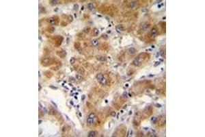 Immunohistochemistry analysis in formalin fixed and paraffin embedded human hepatocarcinoma reacted with ODF3B Antibody (N-term) followed by peroxidase conjugation of the secondary antibody and DAB staining. (ODF3B anticorps  (N-Term))