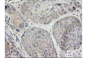Immunohistochemical staining of paraffin-embedded Adenocarcinoma of Human breast tissue using anti-ITFG2 mouse monoclonal antibody. (ITFG2 anticorps)