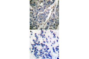 Immunohistochemical staining (Formalin-fixed paraffin-embedded sections) of human breast cancer tissue with SYT1 (phospho T202) polyclonal antibody  without blocking peptide (A) or preincubated with blocking peptide (B) under 1:50-1:100 dilution. (SYT1 anticorps  (pThr202))