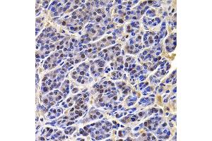Immunohistochemistry of paraffin-embedded human liver cancer using HIRIP3 antibody at dilution of 1:100 (x400 lens). (HIRIP3 anticorps)