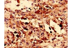Immunohistochemistry analysis of human melanoma using ABIN7172859 at dilution of 1:100