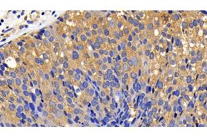 Detection of BCL2L11 in Human Breast cancer Tissue using Polyclonal Antibody to Bcl2 Like Protein 11 (BCL2L11) (BIM anticorps  (AA 2-120))