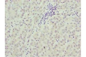 Immunohistochemistry of paraffin-embedded human liver cancer using ABIN7172689 at dilution of 1:100 (TAF5 anticorps  (AA 656-800))