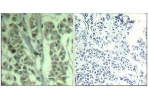 Immunohistochemical analysis of paraffin-embedded human breast carcinoma tissue using c-Cbl(Phospho-Tyr700) Antibody(left) or the same antibody preincubated with blocking peptide(right).