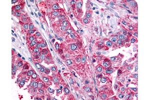 Anti-BAI2 antibody IHC of human Lung, Non-Small Cell Carcinoma. (BAI2 anticorps  (C-Term))