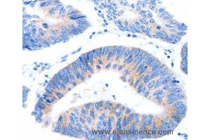 Immunohistochemistry of Human lung cancer using MUC3A Polyclonal Antibody at dilution of 1:60 (MUC3A anticorps)