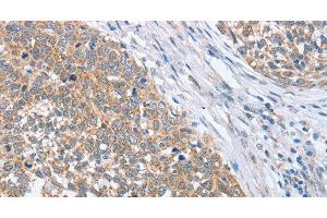 Immunohistochemistry of paraffin-embedded Human cervical cancer tissue using PAPSS1 Polyclonal Antibody at dilution 1:40 (PAPSS1 anticorps)