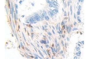 Detection of PDXK in Human Colorectal cancer Tissue using Polyclonal Antibody to Pyridoxal Kinase (PDXK)