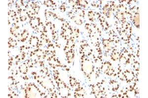 Formalin-fixed, paraffin-embedded human Thyroid stained with TTF-1 Mouse Monoclonal Antibody (8G7G3/1). (NKX2-1 anticorps)