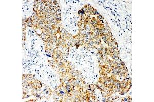 IHC-P: NOX5 antibody testing of human breast cancer tissue (NOX5 anticorps  (C-Term))