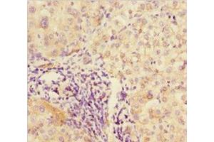 Immunohistochemistry of paraffin-embedded human liver cancer using ABIN7176590 at dilution of 1:100