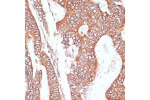 Immunohistochemistry of paraffin-embedded human colon carcinoma using PTPRN2 antibody (ABIN7269710) at dilution of 1:100 (40x lens).