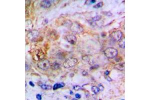Immunohistochemical analysis of Carbonic Anhydrase 2 staining in human lung cancer formalin fixed paraffin embedded tissue section. (CA2 anticorps  (C-Term))